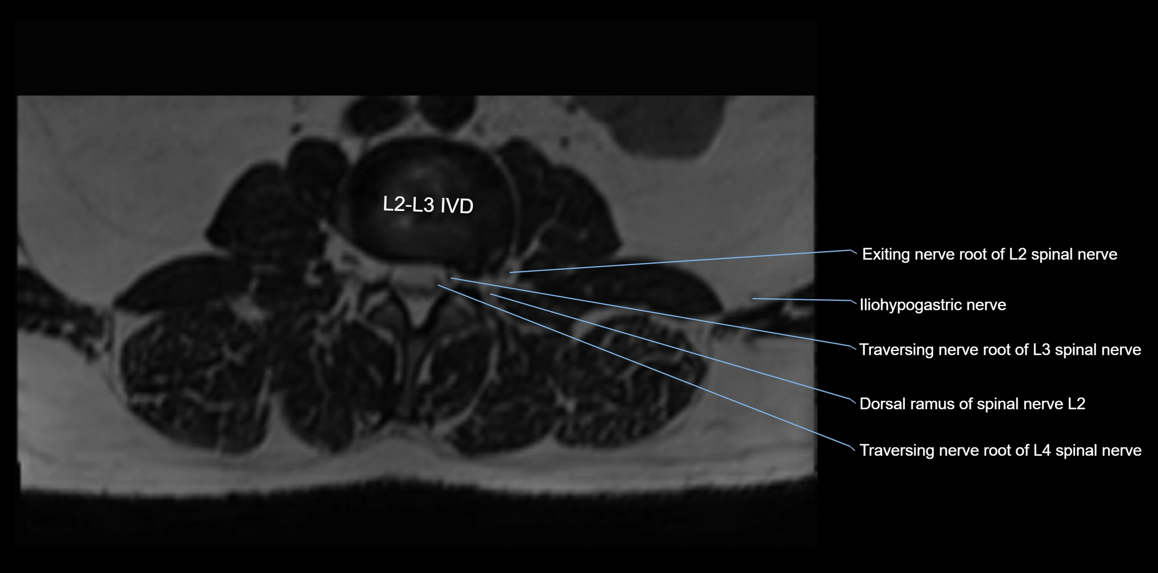 MR lumbosacral plexus axial cross sectional anatomy 3T  radiology  image-img-1008001-00011.webp